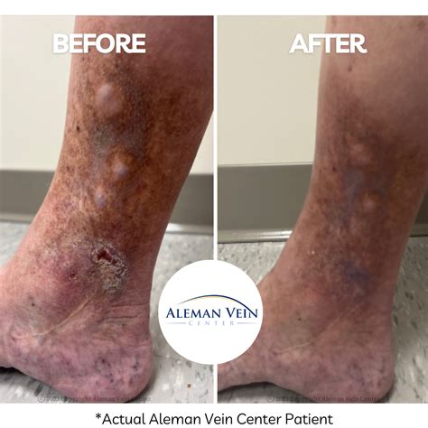 Aleman Vein Center is an Atlanta vein clinic that offers the best treatment for venous leg ulcer ...