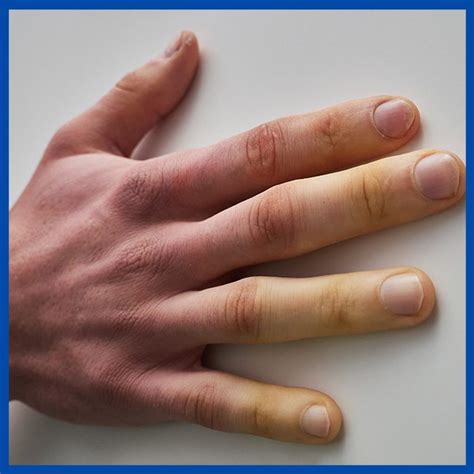 Vibration White Finger - Brandon P. Donnelly, MD