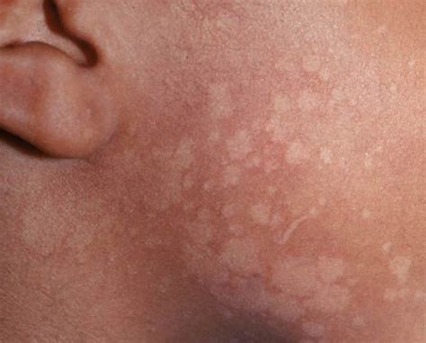 Pityriasis versicolor, causes, symptoms, diagnosis, treatment & prognosis