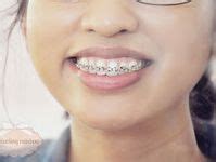 10 Best Fake braces ideas | fake braces, braces, diy braces