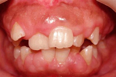 Full Text - Hereditary gingival fibromatosis: Report of four generation ...