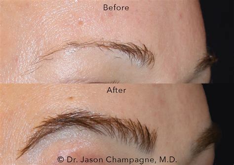 Eyebrow Hair Transplantation Gallery | Beverly Hills Plastic Surgeon - Dr. Jason Champagne