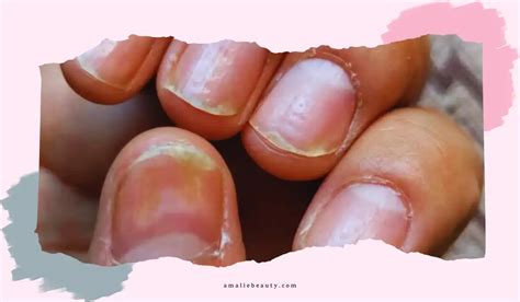 Nail pitting: How Can It Be Recognized And Treated?