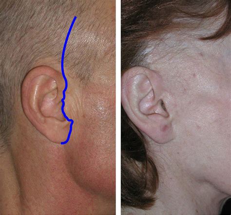 Figure 33 from Complications in facelift surgery and their prevention. | Semantic Scholar