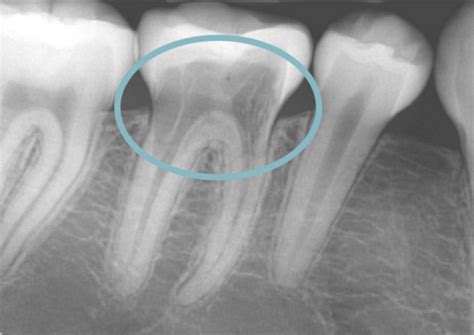 Diving in to Tooth Resorption - Dental Care of Vashon