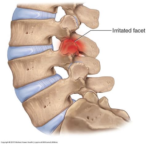 Facet Joint Sprain - Back in Action