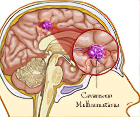 Cavernous Malformation - Causes, Symptoms, Treatment, Prevention