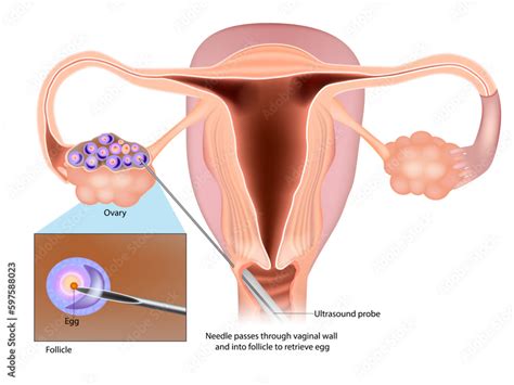 IVF Egg Retrieval technique. Egg retrieval procedure before in vitro fertilization. Stock Vector ...