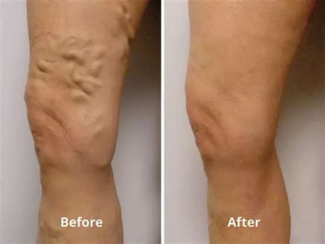 Vein Treatments | Vein Center of Arizona