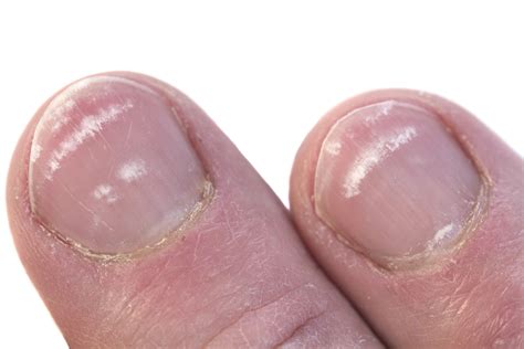 What Causes White Spots on Nails (Leukonychia)?