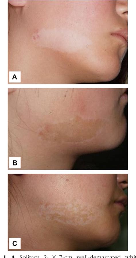 Figure 1 from Recurrence of nevus depigmentosus after an autologous epidermal graft. | Semantic ...