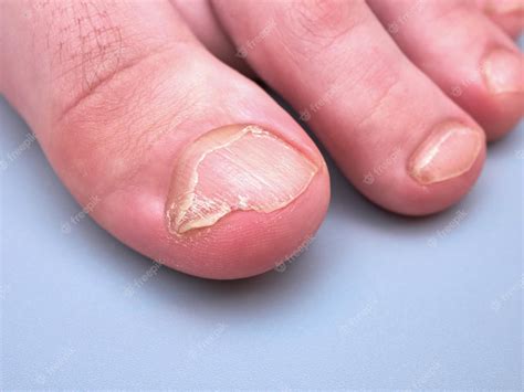 Premium Photo | Foot of a young boy with weak or brittle nails onychoschizia disease isolated on ...