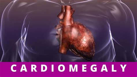 CARDIOMEGALY- what causes cardiomegaly? - YouTube