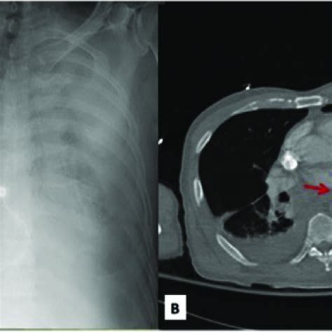 (PDF) Tension hydropneumothorax as the initial presentation of Boerhaave syndrome