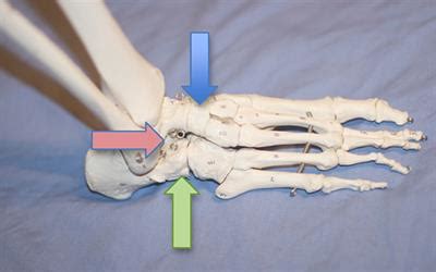 Triple Arthrodesis Foot (Hindfoot Fusion) Procedure & Recovery