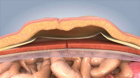 Ventral Hernia Repair by Dr. David W. Ford