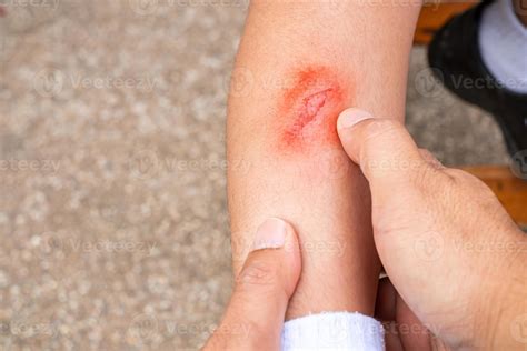 Father's hand holding baby's leg while injured leg ulcer caused by ...