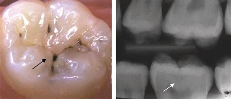 12: Diagnosis and Management of Dental Caries | Pocket Dentistry