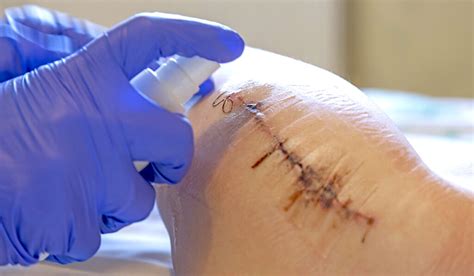 The Importance of Effective Wound Care Treatment for Vitastem Users ...