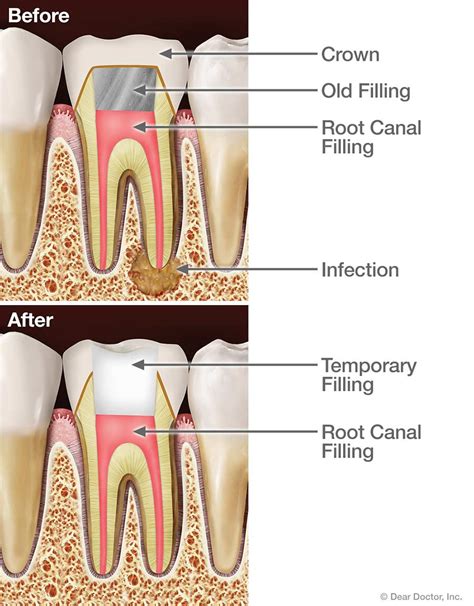 Retreatment | A. K. Bobby Mallik D. M. D. | Durham North Carolina