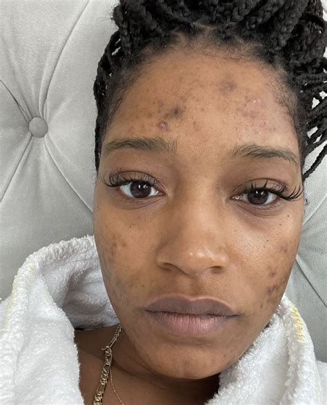 Keke Palmer shares how she covers acne scars after opening up about ...