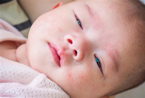 Pink Eye in Newborns: Symptoms, Causes and Treatment