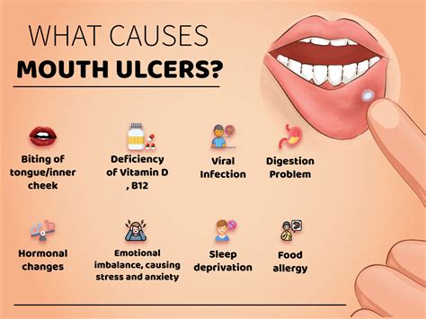 21 Best Home Remedies And Gel For Mouth Ulcers » Lifelonghealth.in