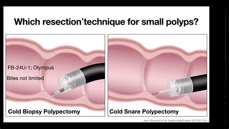 Endoscopy Refresher - Class 17 - Cold Snare Resection - YouTube