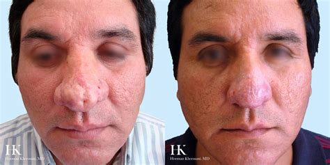 Rhinophyma Treatment Options | Dr. Khorasani