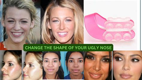 Snub nose? No alternative to plastic surgery in sight?