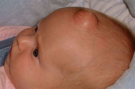 Epidermoid Cyst - Pictures, Symptoms, Causes, Treatment, Removal | HealthMD