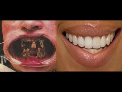 Dental Crowns Before And After