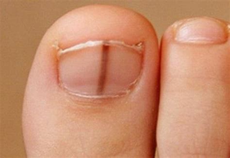 Why Do I Have A Vertical Line On My Toenail - Design Talk