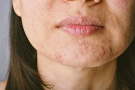 6 Ways To Manage Acne During Menopause - Women's Health and Menopause Center | OB/GYN West ...