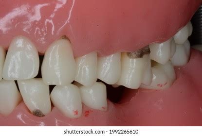 "Subgingival dental calculus" - 5 Ảnh, vector và hình chụp có sẵn | Shutterstock