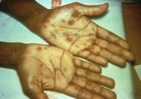 Syphilis | Signs and symptoms: Primary, Secondary, Latent, Tertiary