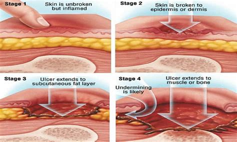 What Are The Five Stages Of Wound Healing - BEST HOME DESIGN IDEAS