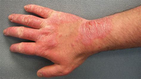 Hand Rashes: Causes, Tips, Prevention, & Treatment