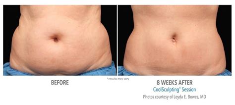 CoolSculpting Treatment NJ - Freeze Your Fat | Slate Medspa