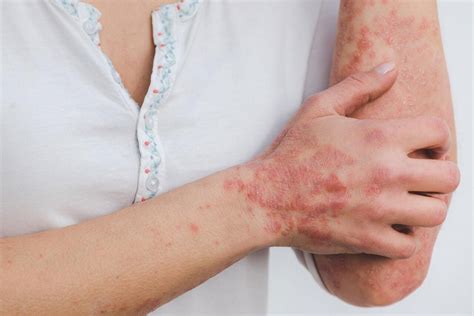 Psoriasis and eczema have complex causes and consequences that researchers are seeking to uncover