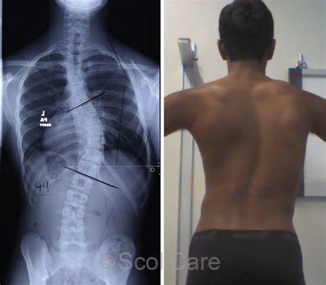 Reduction of severe scoliosis in a 14-year-old male patient