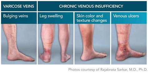 Venous Disease