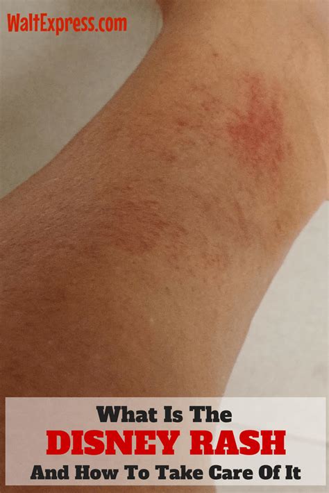 What is the Disney rash and how to take care of it? | Disney rash, Disney world rides, Disney ...