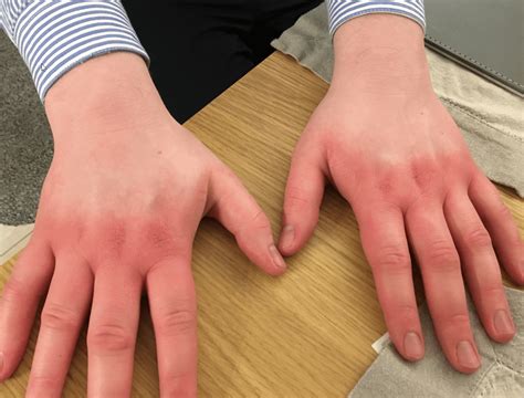 Possible Symptoms? : r/Erythromelalgia