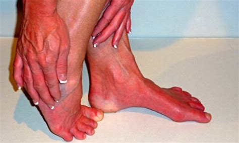 Erythromelalgia - Pila Pharma