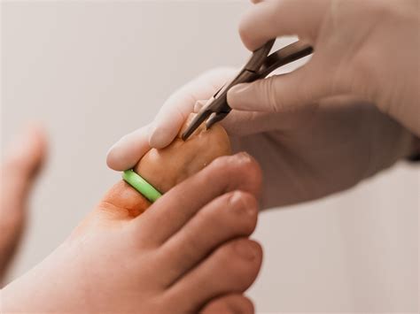 Ingrown Nail Surgery in Penrith, Ryde and other areas