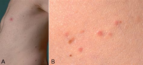 Papular Rash Differential