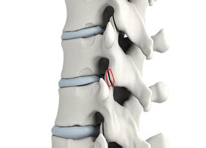 Lumbar Foraminotomy & Facetectomy Washington, D.C. | Bone Spurs Chevy ...