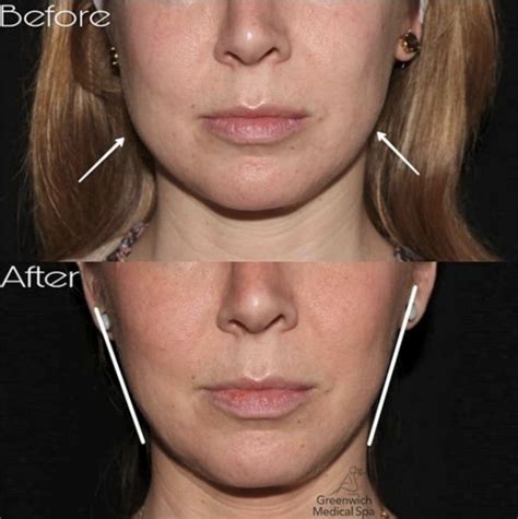 An amazing before and after patient who used botox in her masseter ...