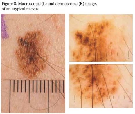 Melanocytic lesions: Effective Management in Primary Care: Part 2 ...